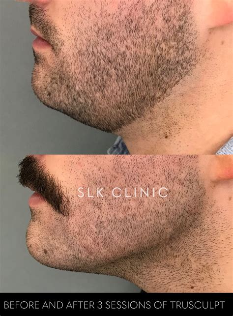 trusculpt id monopolar radio frequency|trusculpt id before and after.